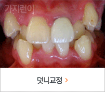 덧니교정