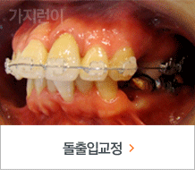 돌출잎교정